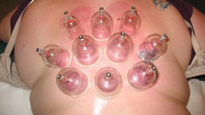 cupping